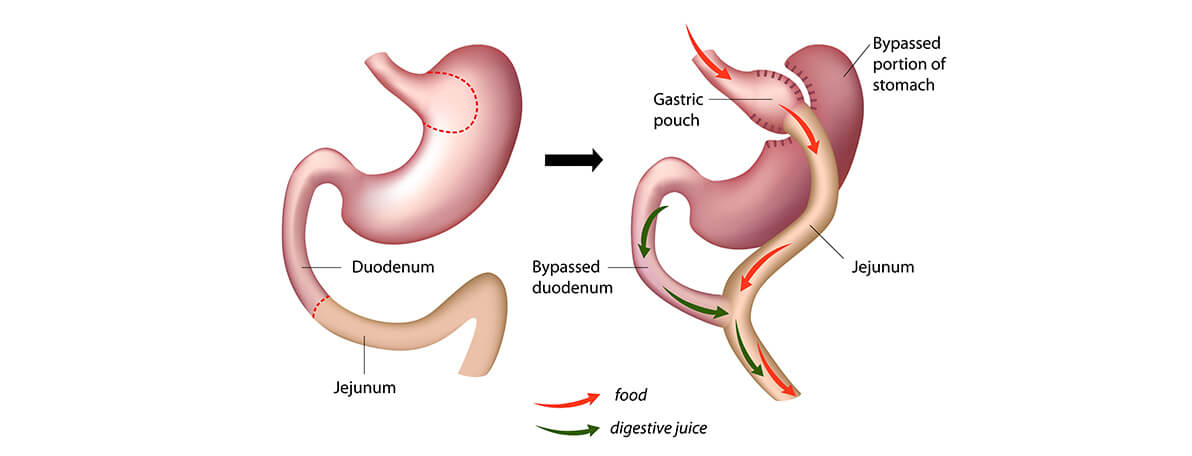 Dr.Samir Website Revisional <br />
Roux-en-Y <br />
Gastric Bypass Services Detailed