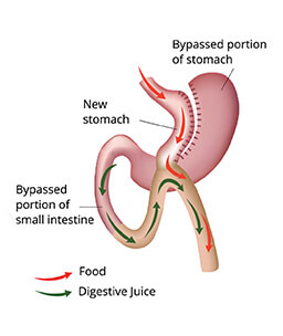 Dr.Samir Website Mini Gastric Bypass Services Detailed