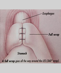 Dr.Samir Website Antireflux Services Detailed