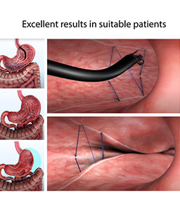 Dr.Samir Website Endoscopic Sleeve <br />
Gastroplasty Services Detailed