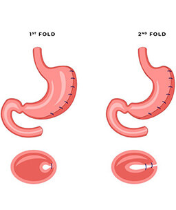 Dr.Samir Website Revisional Gastric Plication Services Detailed