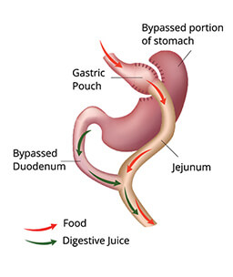 Dr.Samir Website Roux-en-Y Gastric Bypass Services Detailed