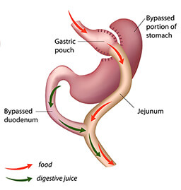 Dr.Samir Website Revisional <br />
Roux-en-Y <br />
Gastric Bypass Services Detailed