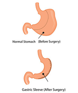 Dr.Samir Website Sleeve Gastrectomy Services Detailed