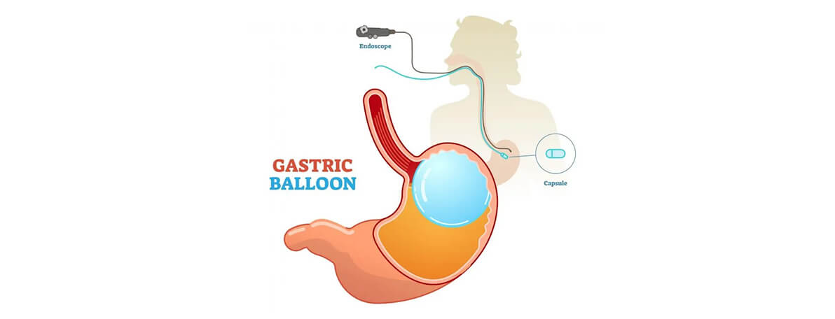 Dr.Samir Website Gastric Balloons Services Detailed