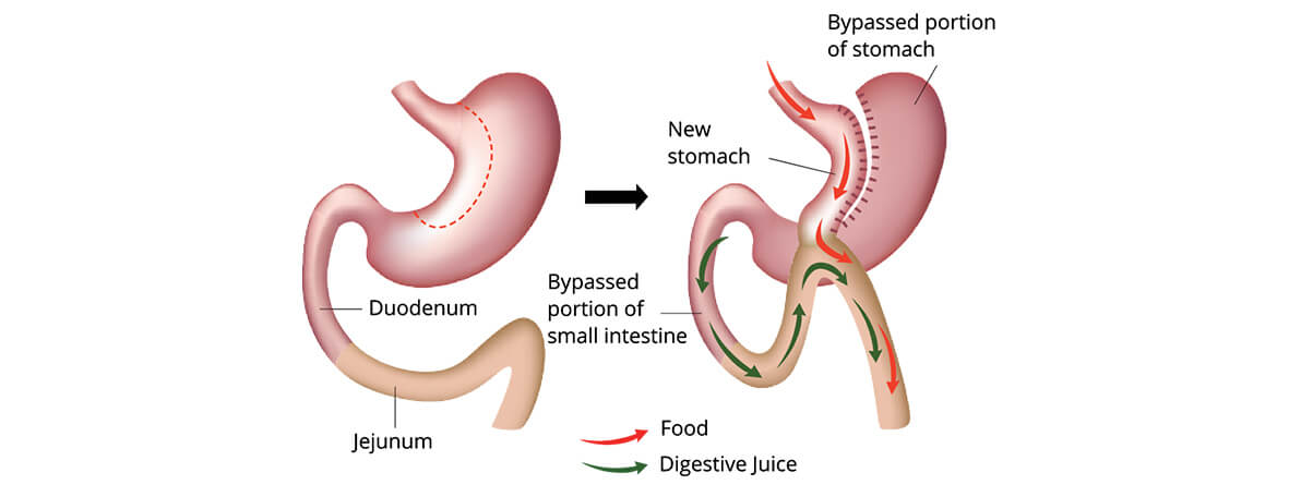 Dr.Samir Website Mini Gastric Bypass Services Detailed