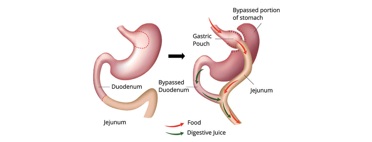 Dr.Samir Website Roux-en-Y Gastric Bypass Services Detailed