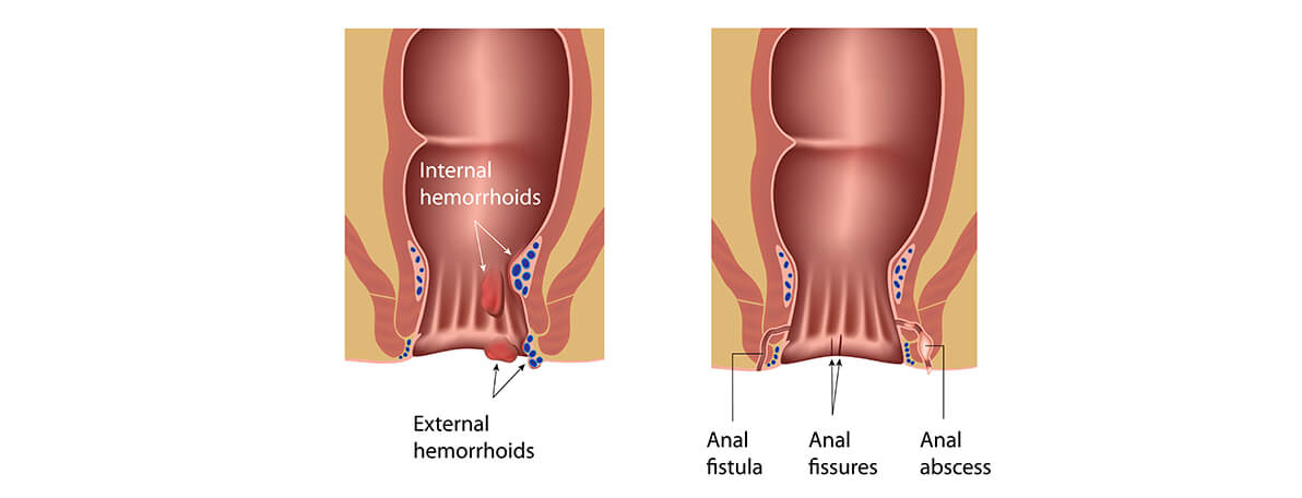 Dr.Samir Website Proctology Services Detailed