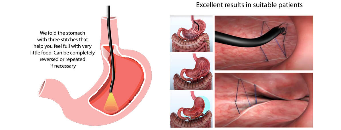 Dr.Samir Website Endoscopic Sleeve <br />
Gastroplasty Services Detailed