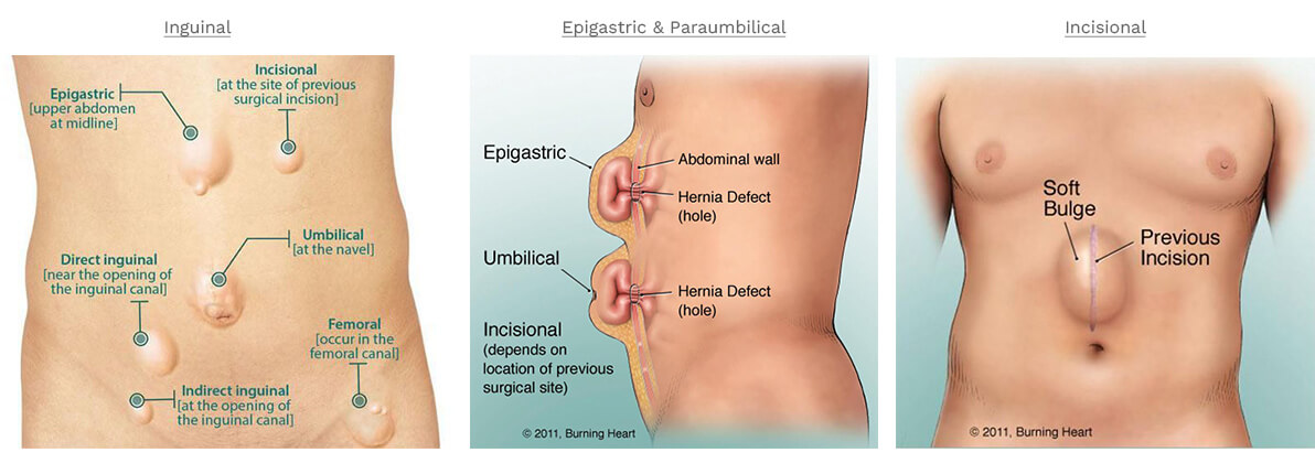 Dr.Samir Website Hernia Services Detailed