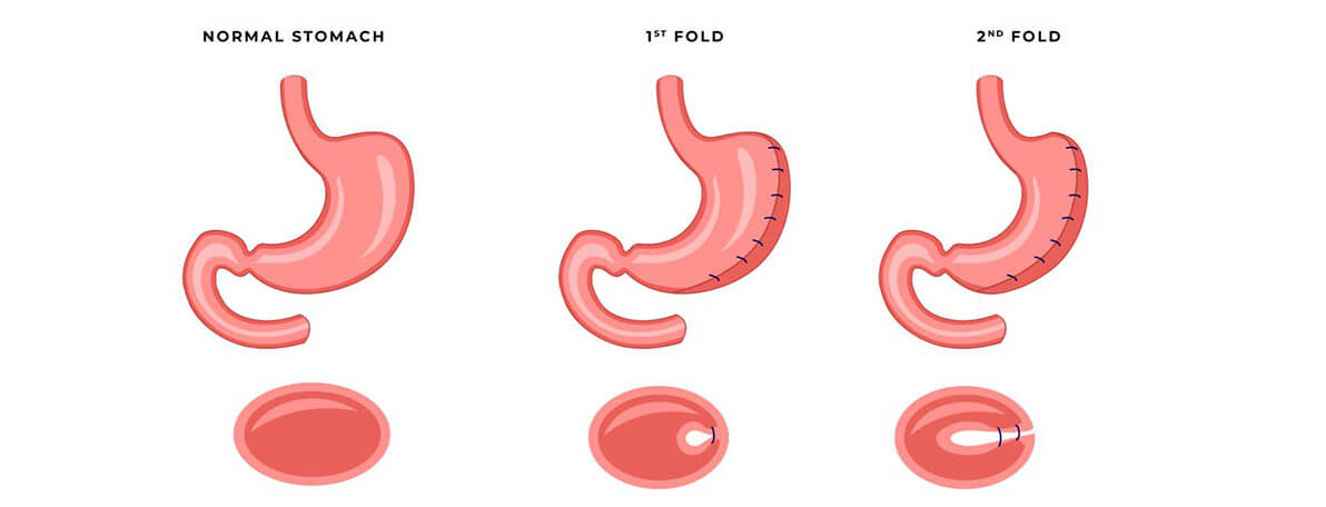 Dr.Samir Website Revisional Gastric Plication Services Detailed